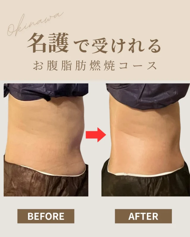 ———  【忙しい女性ほど、お腹から変わる。】
「昔は履けていたお気に入りのズボンが、もう入らない…」
「年々お腹まわりだけ落ちなくなる」
そんなお悩み、実はとても多いんです。  今回ご紹介するお客様も、
仕事・家事・家族のことで大忙し。
気づけば、あれ？お腹周りが前と違う…、
というお悩みがでてきました。  でも、
✔ 1〜2週間ごとのこまめなマッサージケア
✔ ご自宅でのホームケアの実践
✔ お腹に合ったアプローチ
を続けてくださったことで──  ＼履けなかったズボンがすっと入るお腹へ！／
見た目もサイズも、しっかり変化が出ました。  忙しくても“正しい方向に整える”だけで、
お腹まわりはちゃんと応えてくれます。  「昔のズボンやデニムをもう一度履きたい」
「まずはお腹からスッキリしたい」
そんな方は、まずは【お腹脂肪燃焼コース】の体験からどうぞ。  ご予約はプロフィール
@cocorebeau_nago のリンクから
いつでもお待ちしています♡